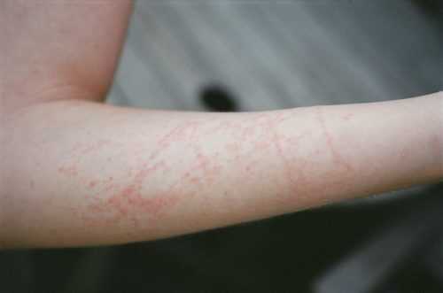 Какие медузы водятся в Азовском море? Жалят ли они людей?