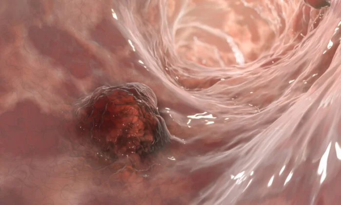 Прорыв в лечении рака прямой кишки: новое лекарство