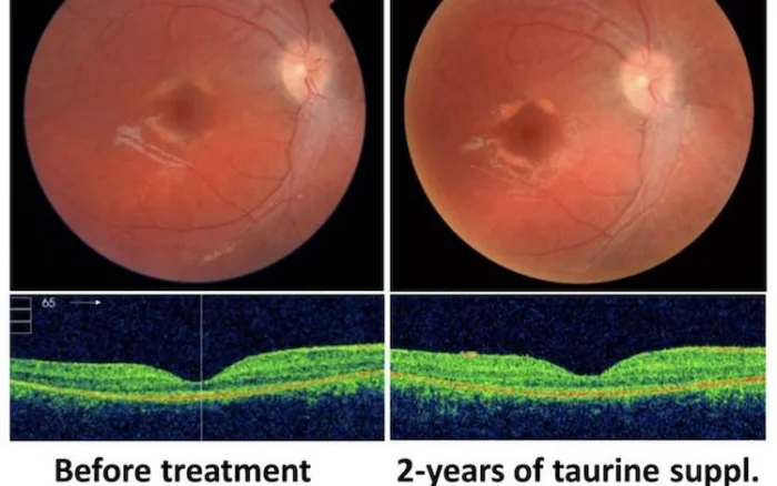 45 новых генов слепоты и нарушений мозга: найдено простое лечение