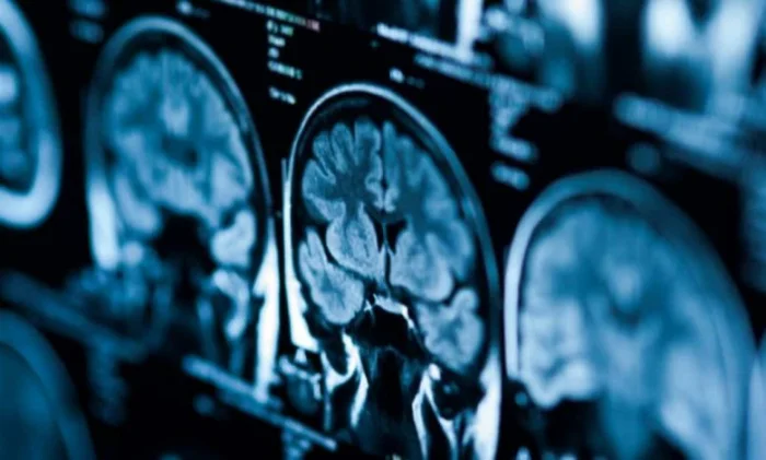 COVID-19 и мозг: потеря IQ как при 20 годах старения