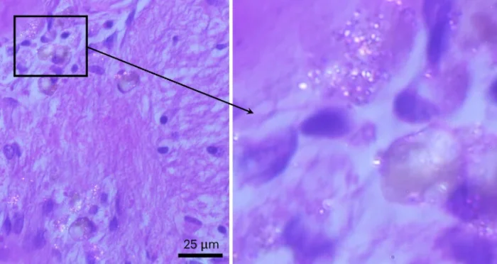 Учёные обнаружили микропластик в мозге, но его влияние на здоровье пока неясно