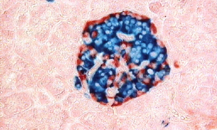 Уникальная трансплантация клеток приближает излечение диабета