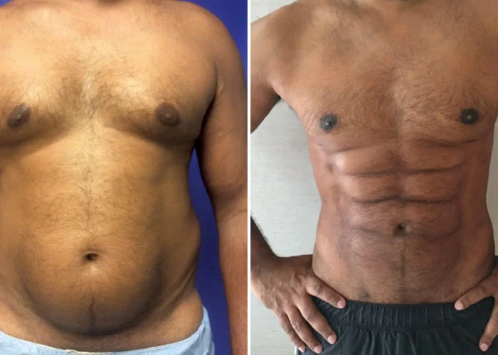 Новая операция превращает жир на животе в рельефный пресс