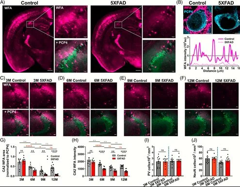 Почему пациенты с Альцгеймером перестают узнавать близких: новая гипотеза