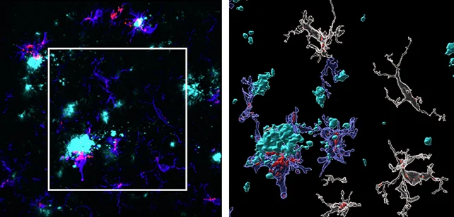 Учёные обнаружили в мозге ранний предвестник болезни Альцгеймера