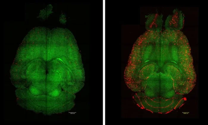 Новый метод лечения болезни Альцгеймера показал высокую эффективность в доклинических испытаниях